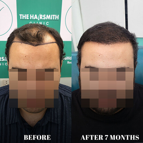 After 07 months hair transplant result update at the hairsmith clinic delhi india (4)