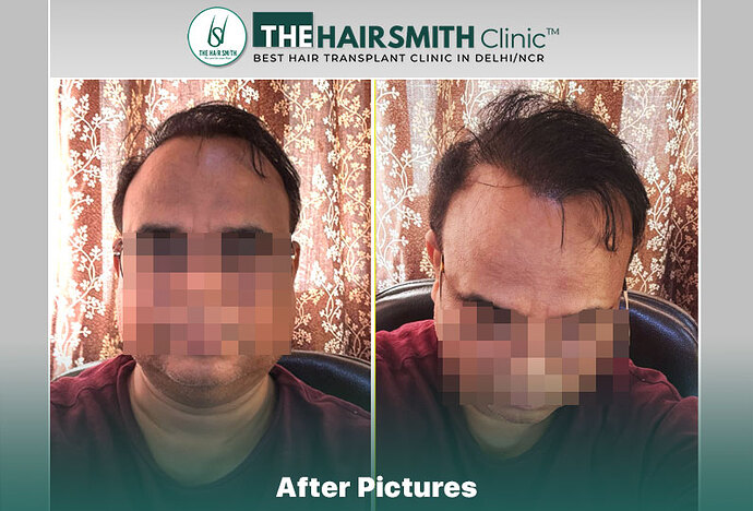 best hair transplant in india - after 17 months result - the hairsmith clinic