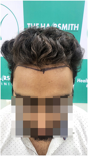 Before Hair Transplant - Norwood Stage 2 - photo 2- The Hairsmith Clinic