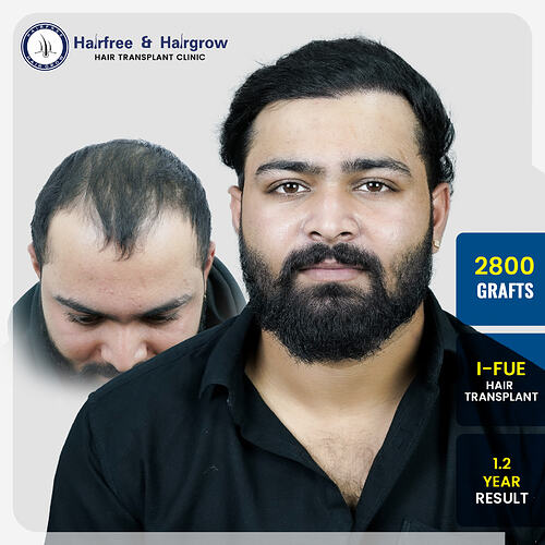dipesh-pansare-2800-grafts-i-fue-hair-transplant-14-month-result-pune.jpg