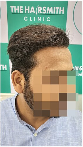 After Hair Transplant Result - The Hairsmith Clinic (4)