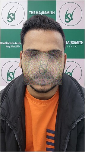 After Hair Transplant Result -04 Months Update - The Hairsmith Clinic (1)