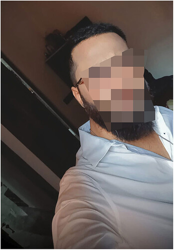 the hairsmith clinic - 11 months hair transplant result update - 2