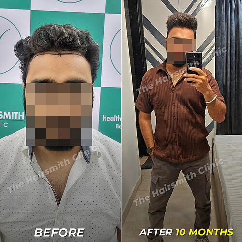 Hair Transplant Result in 10 Months - Before-After - The Hairsmith Clinic 1