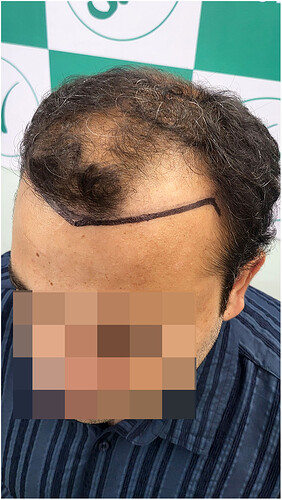 Before Hair Transplant HS 819- The Hairsmith Clinic Delhi India - (4)