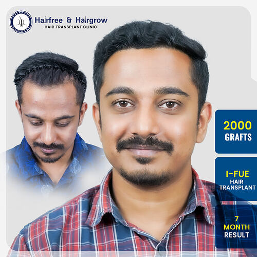 sukrut-daundkar-hair-transplant-result-india-hairfree-hairgrow-clinic.jpg