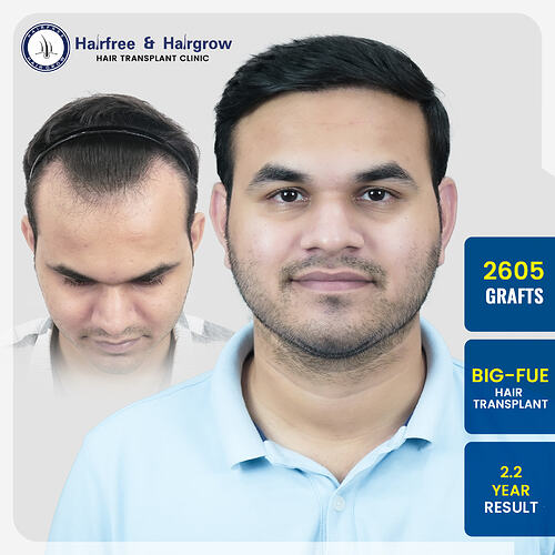 sanket-chinchole-2605-grafts-big-fue-hair-transplant-2-2-year-result-pune.jpg
