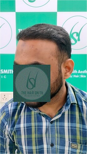 After Hair Transplant Result (4) in India  form The Hairsmith Hair Transplant Clinic