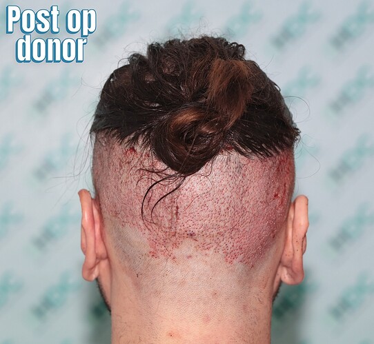 6 Back donor post op