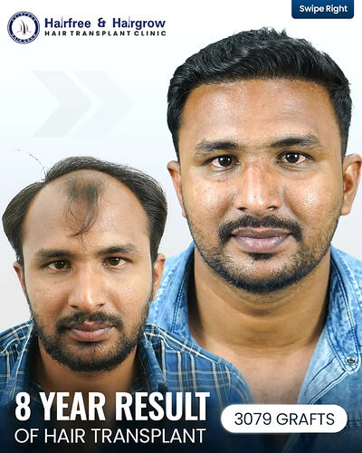 8 Years After Hair Transplant- Still Natural. A hair transplant is not just about immediate res