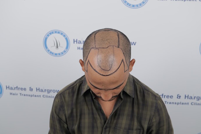 hair line marking
