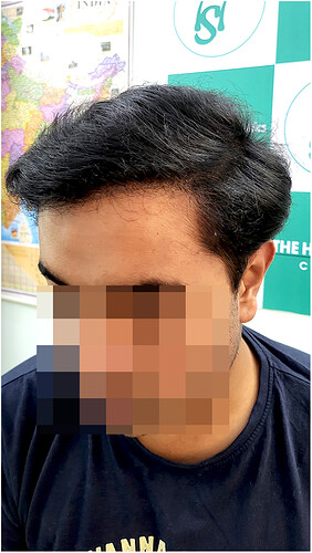 The Hairsmith Hair Transplant Result - After 1 year  Update (5)