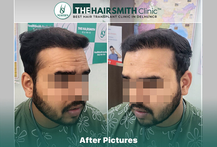 after hair transplant result - the hairsmith clinic delhi india #HairTransplant #URFUEHairTransplant #TheHairsmithClinic