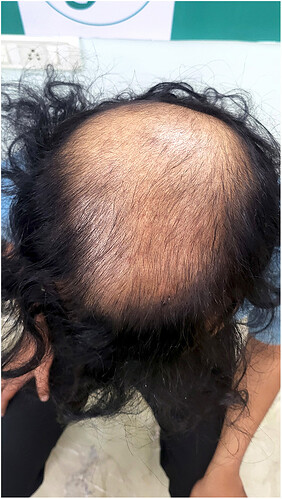Before Hair Transplant HS 822- The Hairsmith Clinic Delhi India (2)