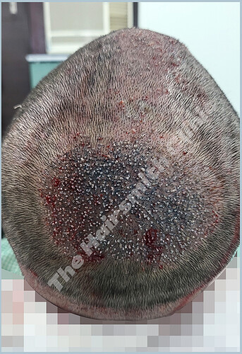 Grafts placement - HS 818 - The Hairsmith Clinic Delhi India - image 1