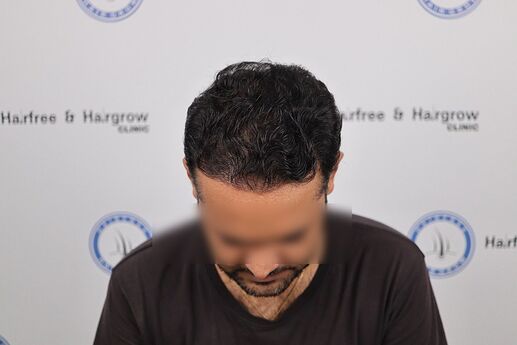 after 1 year hair transplant result at hair free and hair grow clinic