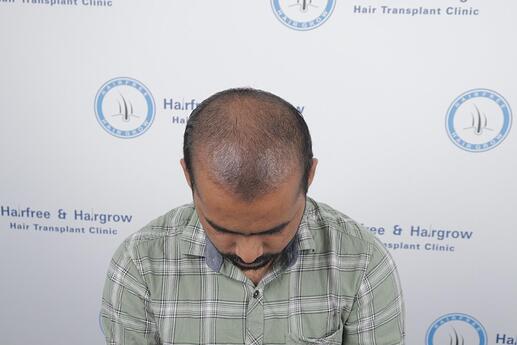 after 1 month shedding phase