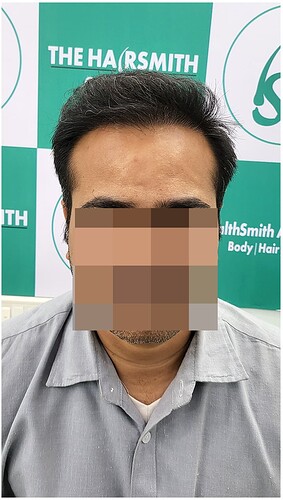 After 8 months hair transplant result - 1 the hairsmith clinic