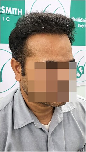 After 8 months hair transplant result - 2 the hairsmith clinic