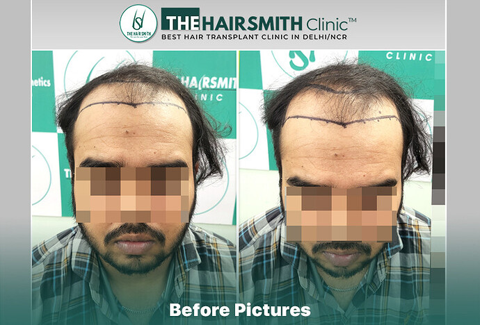 Before Hair Transplant HS 840- The Hairsmith Clinic Delhi India #HairTransplant