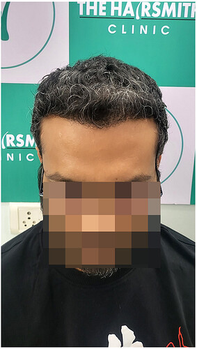 Hair Transplant Result - After 06 Months -  photo 2 - The Hairsmith Clinic