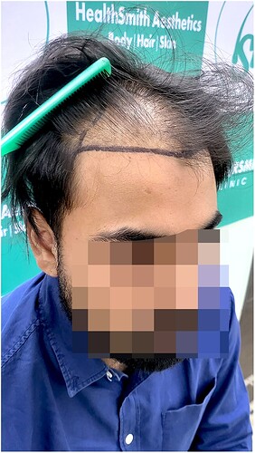 Before Hair Transplant HS 826- The Hairsmith Clinic Delhi India - 4