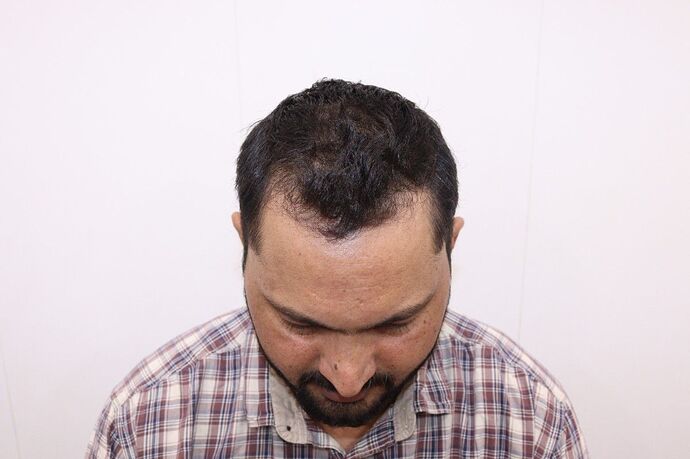before Transplant
