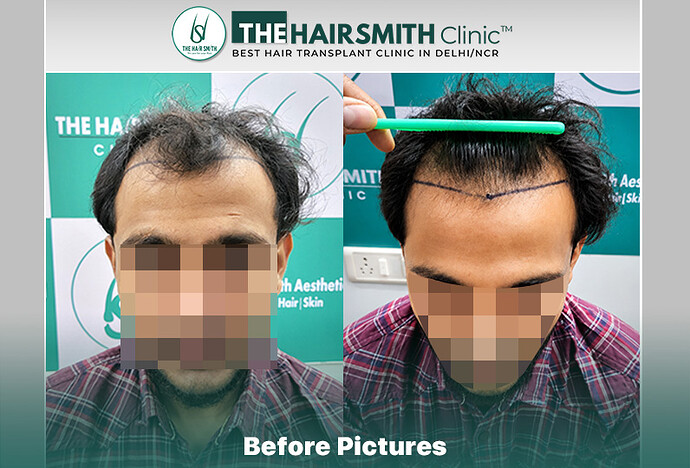 Before Hair Transplant HS 845- The Hairsmith Clinic Delhi India - #hairtransplant