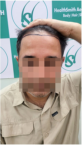 Before Hair Transplant Picture 2 - The Hairsmith Clinic