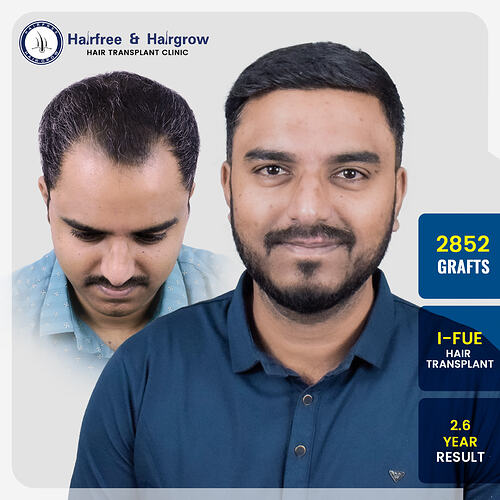 2852-grafts-i-fue-hair-transplant-2-6-year-result-mayur-khairnar-pune.jpg