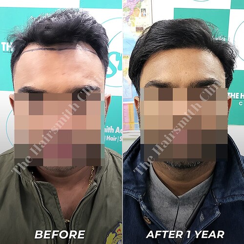 Hairsmith Hair Transplant Result - After 1 year  Update (1)