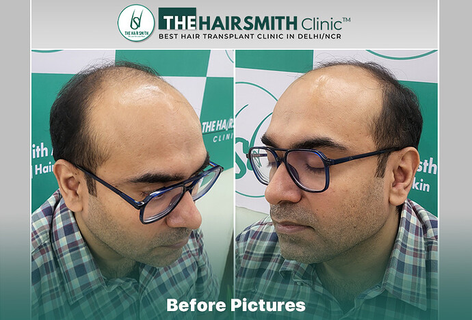 Before Hair Transplant HS 836- The Hairsmith Clinic Delhi India - #hairtransplant #norwoodstage6