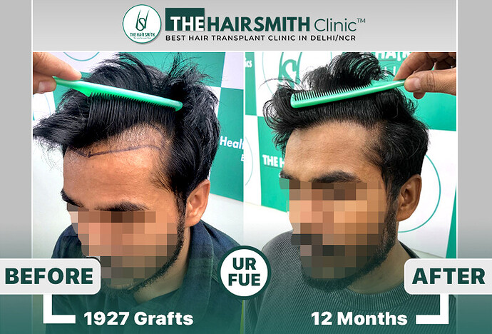 #hairtransplant #hairsmithhairtransplantresults #thehairsmithclinicdelhi #hairtransplantdelhibest