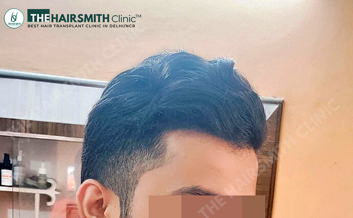 After Hair Transplant - 06 Months Update - Image 3 - The Hairsmith Clinic