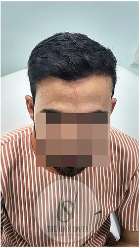 After 11 months hair transplant result update - the hairsmith clinic 2