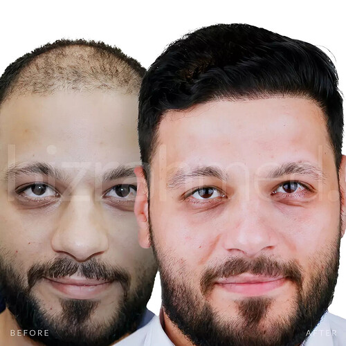 hair-transplant-before-and-after