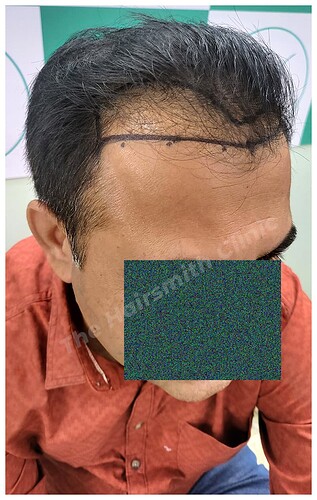 Before Hair Transplant Picture - The Hairsmith Clinic B