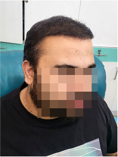 After Hair Transplant Result - The Hairsmith Clinic Delhi India (2)