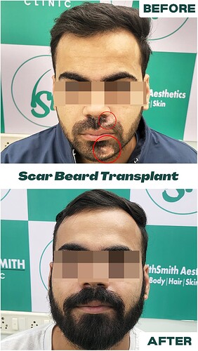 Beard Transplant Result - After 08 Months - The Hairsmith Clinic Delhi India - 1