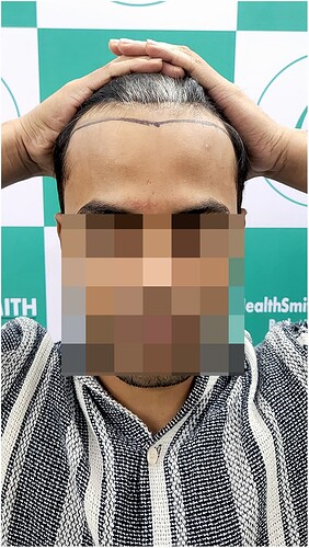 Before Hair Transplant HS823- The Hairsmith Clinic Delhi India (a)
