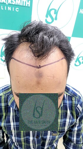 Patient Norwood stages 3 - Before  Picture (3) - The Hairsmith Hair Transplant Clinic