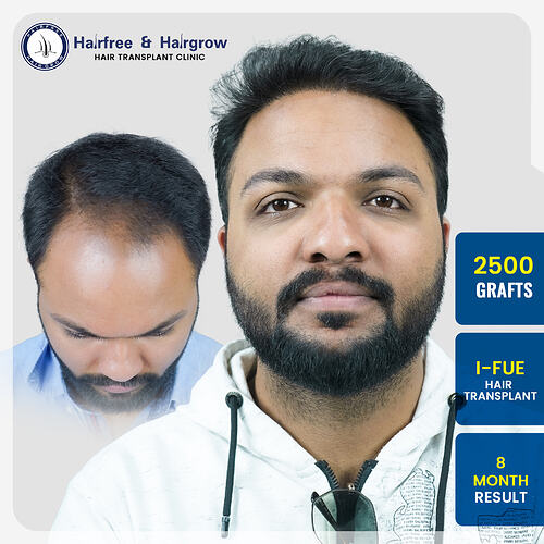 2500-grafts-i-fue-hair-transplant-8-month-result-nilesh-gorde-pune.jpg