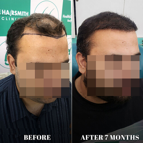 After 07 months hair transplant result update at the hairsmith clinic delhi india (3)