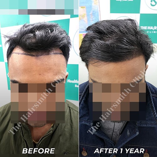 Hairsmith Hair Transplant Result - After 1 year  Update (2)