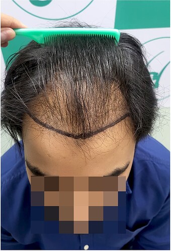 Before Hair Transplant HS 826- The Hairsmith Clinic Delhi India - 2