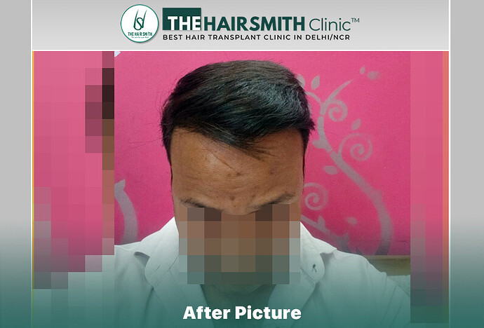 14 months hairsmith hair transplant result - the hairsmith clinic delhi #hairtransplant