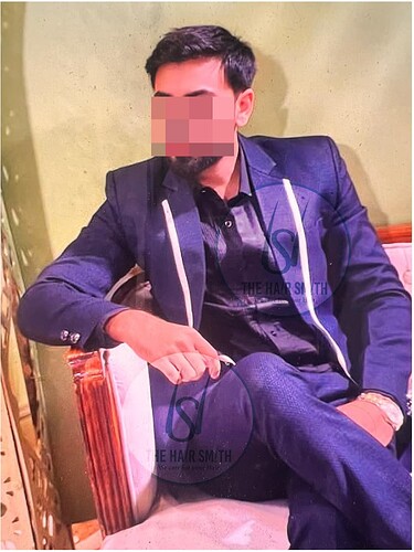 The Hairsmith Clinic - 2 years hair transplant result