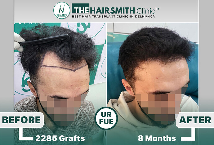 the hairsmith clinic hair transplant result #hairtransplant #hairsmithhairtransplantcost