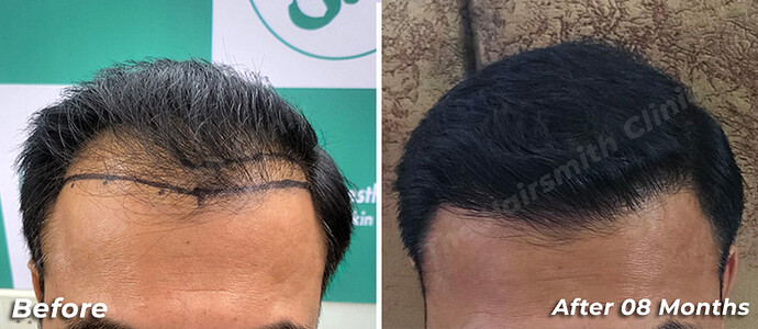 Best Hair Transplant Result - After 08 Months Update - The Hairsmith Clinic Delhi India