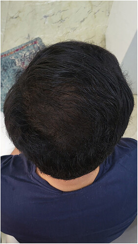 The Hairsmith Hair Transplant Result - After 1 year  Update (3)